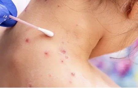 Қызылша ауруының эпидемиологиялық жағдайы