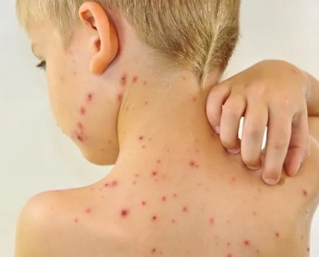 Қызылшаның алдын алу шаралары