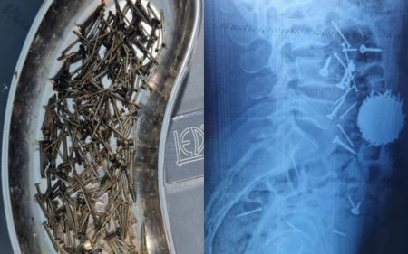 Өзбекстанда науқастың асқазанынан 200 грамм шеге шықты